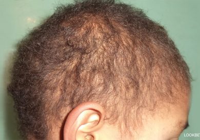 Monilethrix Genetic Hair Disorder