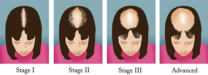 Hair Loss Stages in Women | Marcey Grant, Look Beyond Beauty